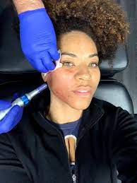 microneedling aftercare tips