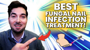 fungal nail best treatment