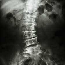 scoliosis novus spine pain center