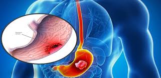 What are treatments for stomach cancer? Stomach Cancer Types Causes And Symptoms Of Stomach Cancer