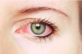 pink eye symptoms treatment more