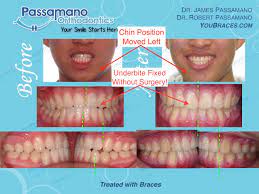 This alignment therapy produces similar results as the traditional braces. Underbite Class 3 Fixed With Braces Only No Surgery Amazing Finish Passamano Orthodontics