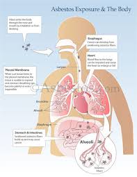 Lung cancer is a leading type of cancer — and a leading killer — in the united states every year. Asbestos Exposure Signs Symptoms Risks Long Term Exposure Mesothelioma 2020