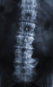 183 Herniated Disc X Ray Stock Photos, Pictures & Royalty-Free Images -  iStock
