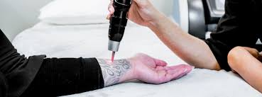 vancouver picosure fast laser tattoo