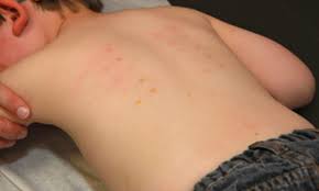 best homeopathic treatment for tinea