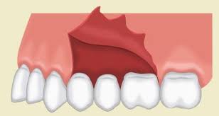 flap design in dento alveolar surgery