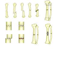 Types Of Bone Fractures Interactive Anatomy Guide