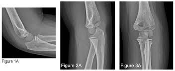 (b) x ray showing medial epicondyle fracture fixed with two parallel k wires; How To Avoid Missing A Pediatric Elbow Fracture Acep Now