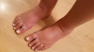 how to relieve swollen feet and ankles