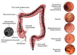 Check spelling or type a new query. Kolonoskopiya Videokolonoskopiya Fks Dlya Obledovaniya Tolstoj Kishki Pod Sedaciej Narkozom