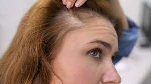 female pattern baldness symptoms