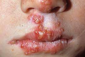 cold sores stock image m260 0217