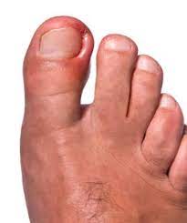 is my ingrown toenail causing my toe to