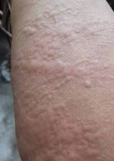 Mề đay không phải là “bê.nh của da” mà là bê.nh của hệ miễn dịch, khí huyết Rất nhiều người khi bị mề đay đều nghĩ đơn giản rằng: “Da mình dị