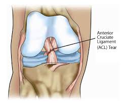 torn anterior cruciate ligament is