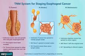 esophageal cancer sing grades