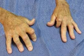 Here's why diagnosing psoriatic arthritis early is key, and what symptoms to watch for. What Is Psoriatic Arthritis National Psoriasis Foundation