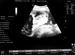 Possible causes, signs and symptoms, standard uterine scarring: Jaypeedigital Ebook Reader