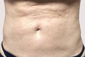fibrosis after lipo how to get rid of