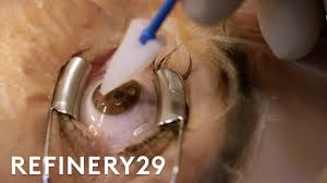 Lasik does not correct presbyopia, but some individuals with the condition choose to have monovision. What Getting Laser Eye Surgery Is Really Like Macro Beauty Refinery29 Youtube