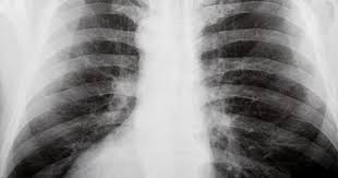 Answer:the chest part is covered by rib cage inside the rib cage there is heart , lungs. Intercostal Neuralgia