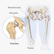 fem stress fracture symptoms