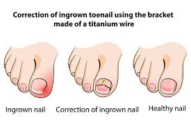 dublin ingrown toenail treatment