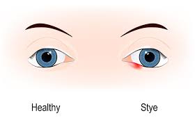 swollen eyelid causes and treatment