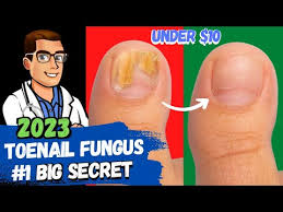 best toe nail fungus treatment 2023 4