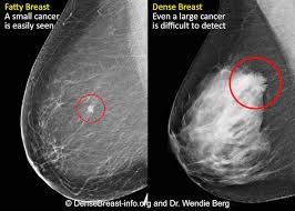 Advancements in technology may also mean breast cancer screening with ultrasound is an acceptable alternative for women in here are 5 expert tips to do right now. Mammography 3d Mammography Tomosynthesis Densebreast Info Inc