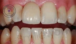 We did not find results for: Dental Implants Liverpool 94 M Cost Replace Missing Teeth In 2020