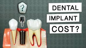 how much do dental implants cost you