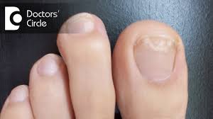 how to manage white spot on toenail