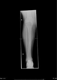 A maisonneuve fracture should be considered in all patients with medial ankle tenderness following trauma Maisonneuve Fracture Radiology Reference Article Radiopaedia Org