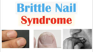 brittle nail syndrome causes signs