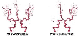 Current jōyō kanji are those on a list of 2,136 characters issued in 2010. é–‰å¡žæ€§è„³è¡€ç®¡éšœå®³ è„³è¡€ç®¡éšœå®³ å³¶æ ¹å¤§å­¦åŒ»å­¦éƒ¨è„³ç¥žçµŒå¤–ç§'å­¦è¬›åº§