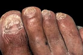 nail foot fungus florida foot and ankle
