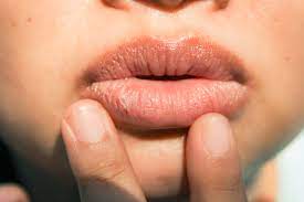6 major causes of chapped lips and how