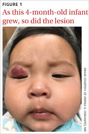 infant with red eyelid lesion mdedge