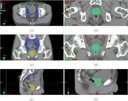 proton therapy planning and image