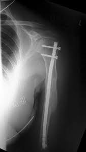 non union of humeral fractures