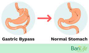 gastric byp reversal what happens