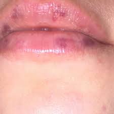 white spots on lip after juvederm photo