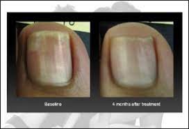 nyc cost of laser toenail fungus