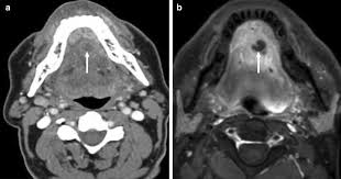 mri of acute neck infections evidence