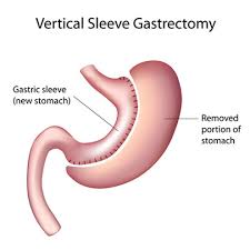 bariatric surgery which procedure is