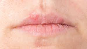 home remes coping with cold sores