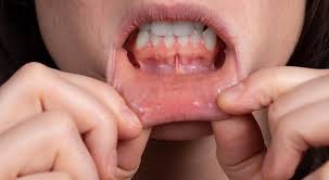 unmasking the culprits of canker sore