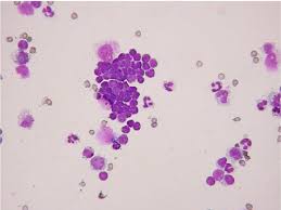 lymphorrhagic effusion collected from